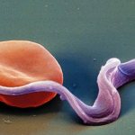 Chronic toxoplasmosis