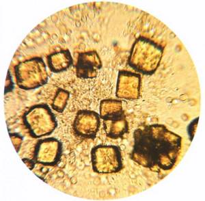 Кристаллы мочевой кислоты под микроскопом