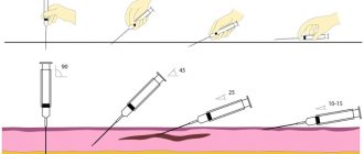 Subcutaneous injection into the shoulder, abdomen, thigh. Technique of execution, introduction